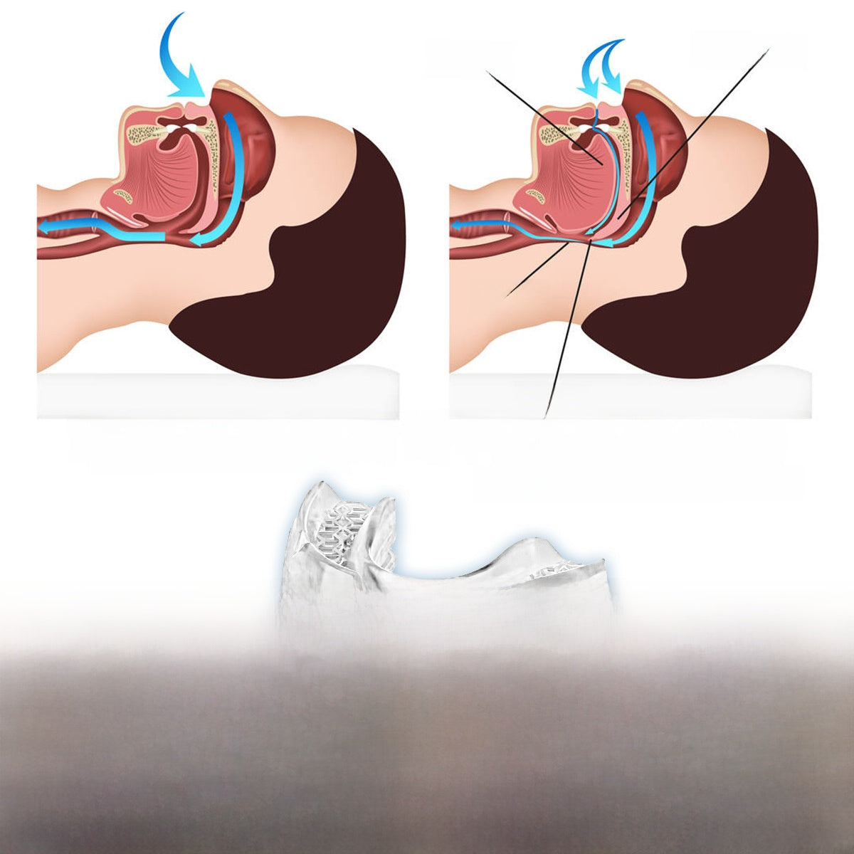 Anti Snoring Mouthpiece